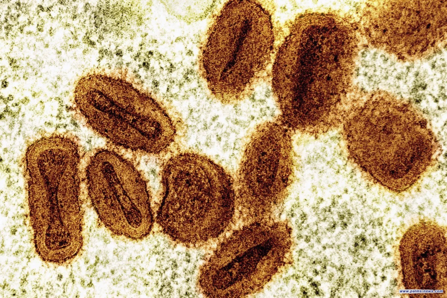 نيويورك تؤكد أول إصابة بسلالة «جدري القردة» الجديدة... والحصبة تتفشى في تكساس